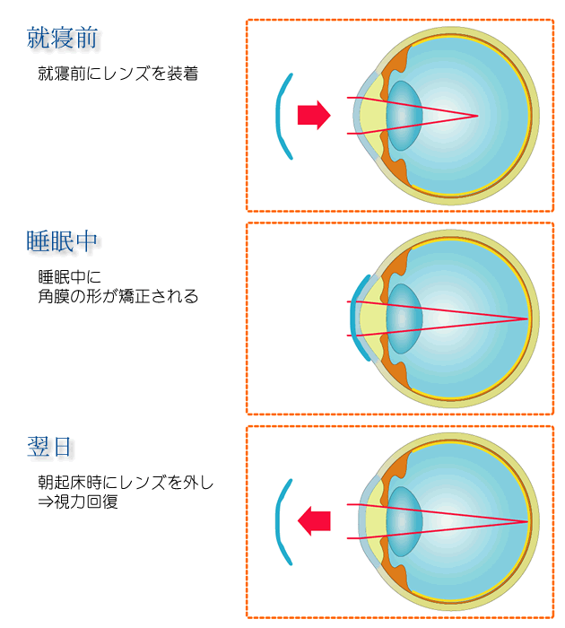 オルソケラトロジー